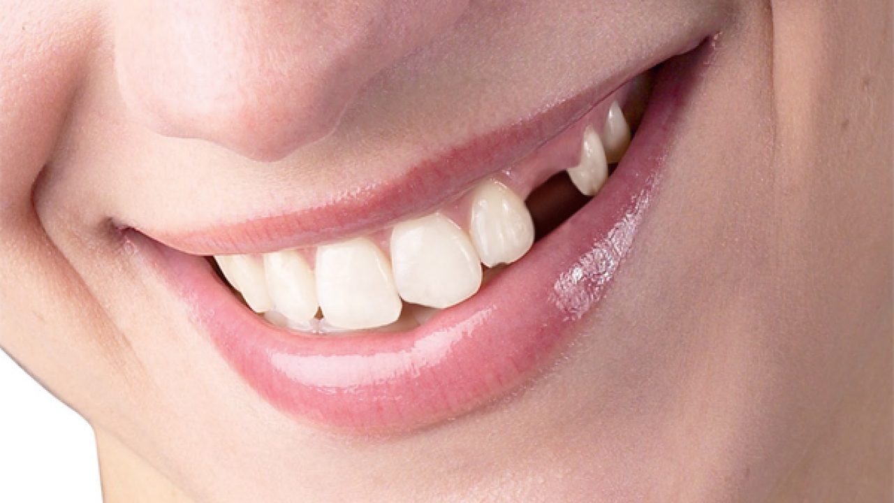 Nằm Mơ Thấy Rụng Răng Giải Mã Điềm Báo Và Con Số May Mắn 1 Nằm mơ thấy rụng răng là điềm báo gì?